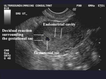 Fetal Anomalies Associated With Breech Presentation